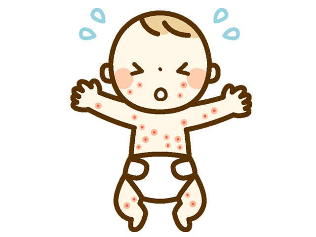 アトピー性皮膚炎の症状